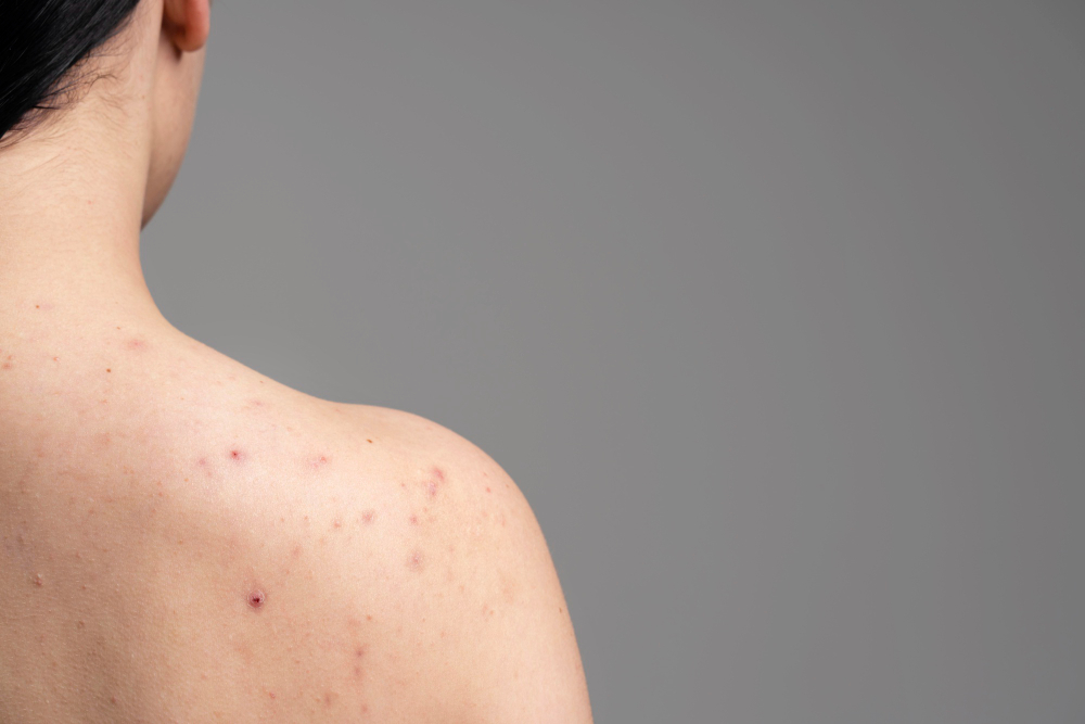 The Acne Remedy: From Diet to Skincare Routine